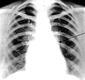 Пример рентгенограммы митрального стеноза