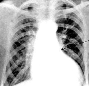 Пример рентгенограммы аортальной недостаточности