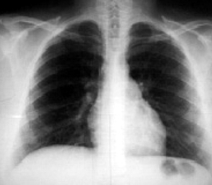 Нормальная рентгенограмма грудной клетки