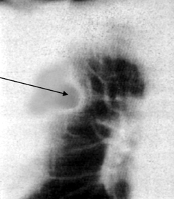 рентгенограмма туберкулезной каверны