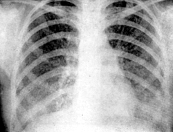 Рентгенограмма легких при остром миллиарном туберкулезе