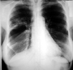 Рентгенограмма прямой проекции ограниченного затемнения легочного поля при правосторонней пневмонии