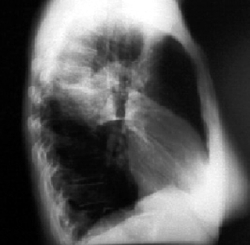 Рентгенограмма боковой проекции ограниченного затемнения легочного поля при правосторонней пневмонии
