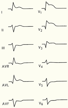 ЭКГ острого переднего Q-инфаркта миокарда левого желудочка + БПНПГ + БПВЛНПГ