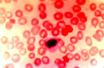 Широкоцитоплазменный лимфоцит